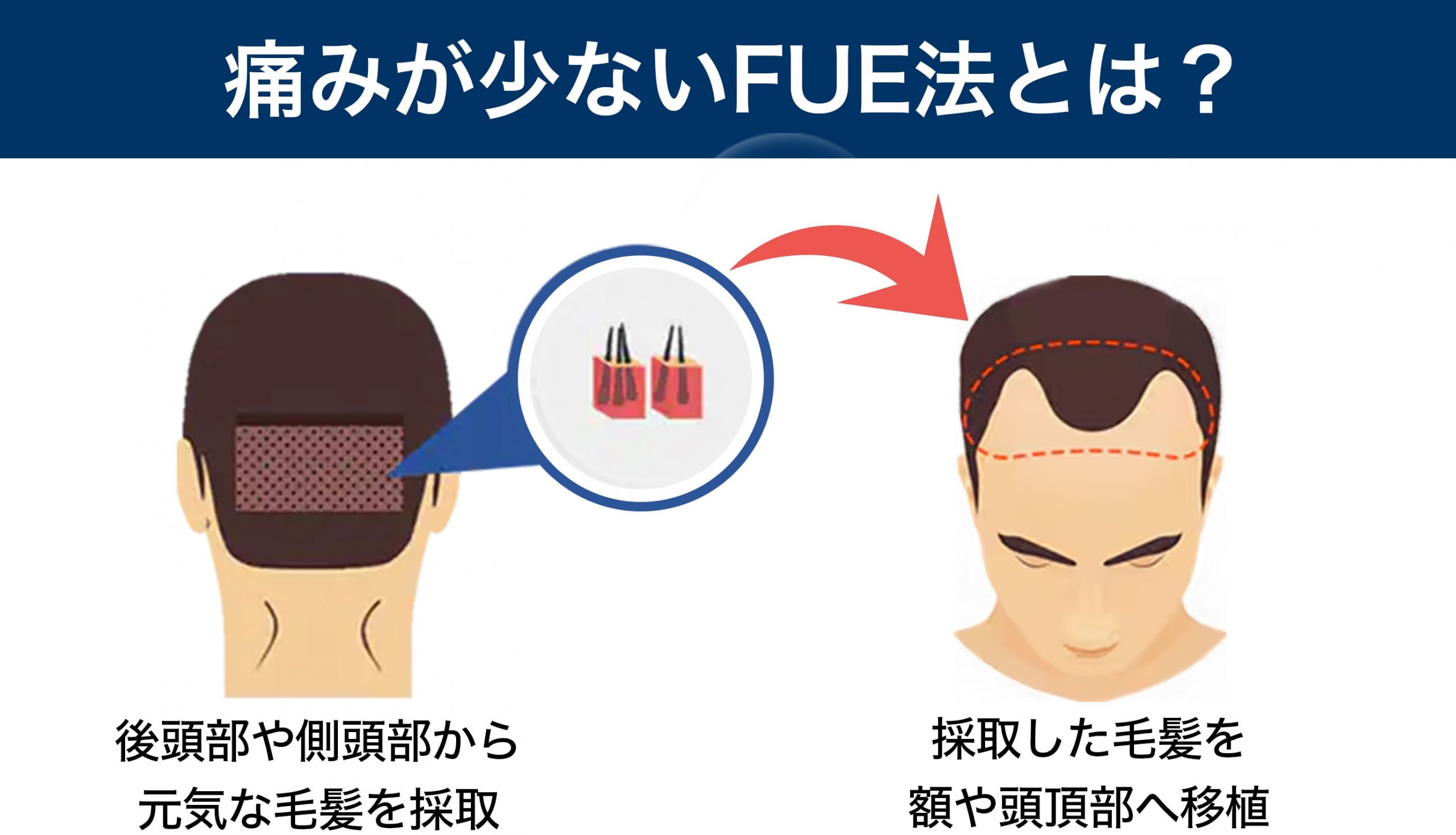 FUSS法より痛みが少ない!自毛植毛におすすめのFUE法とは?<br />