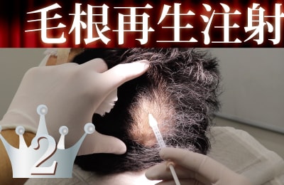 毛根再生注射