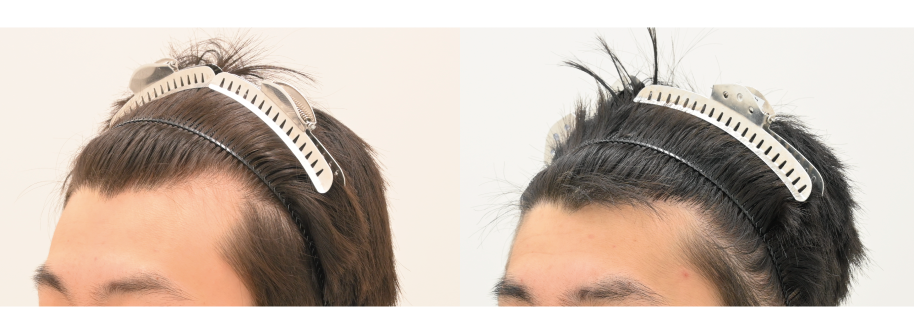 自毛植毛の症例写真 治療前と治療10ヶ月後の比較
