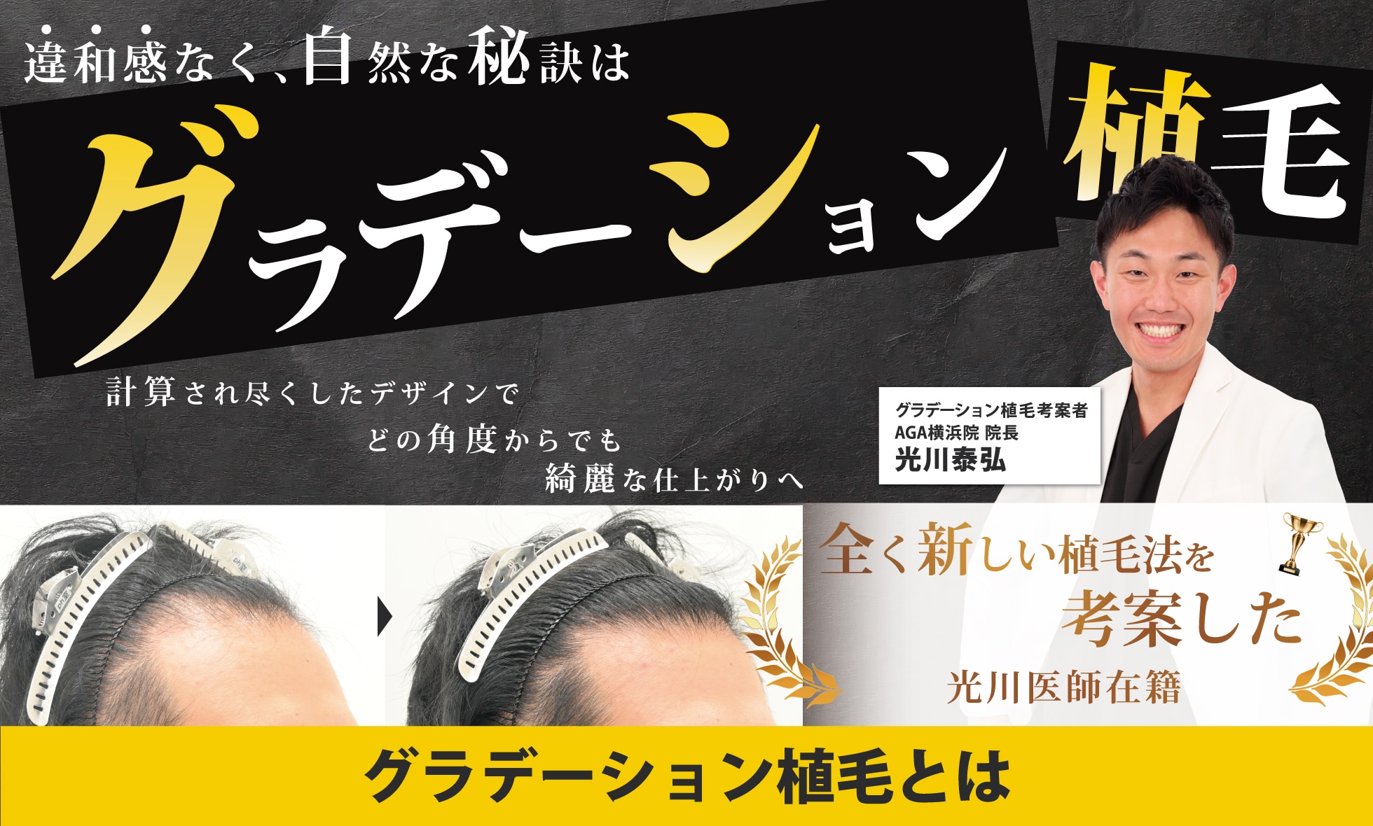 横浜市(神奈川)でAGA治療するなら湘南AGAクリニック横浜院！自毛植毛はおまかせ！