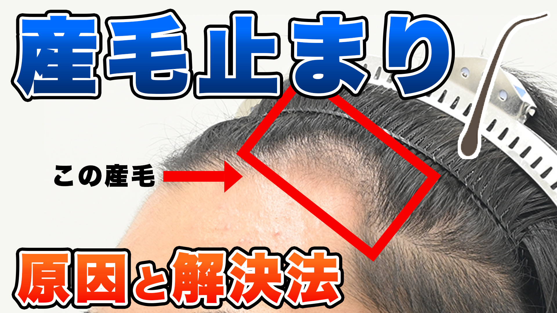 プロペシアやミノタブで生えた産毛は継続すれば伸びるのか？産毛止まりの原因と解決方法！