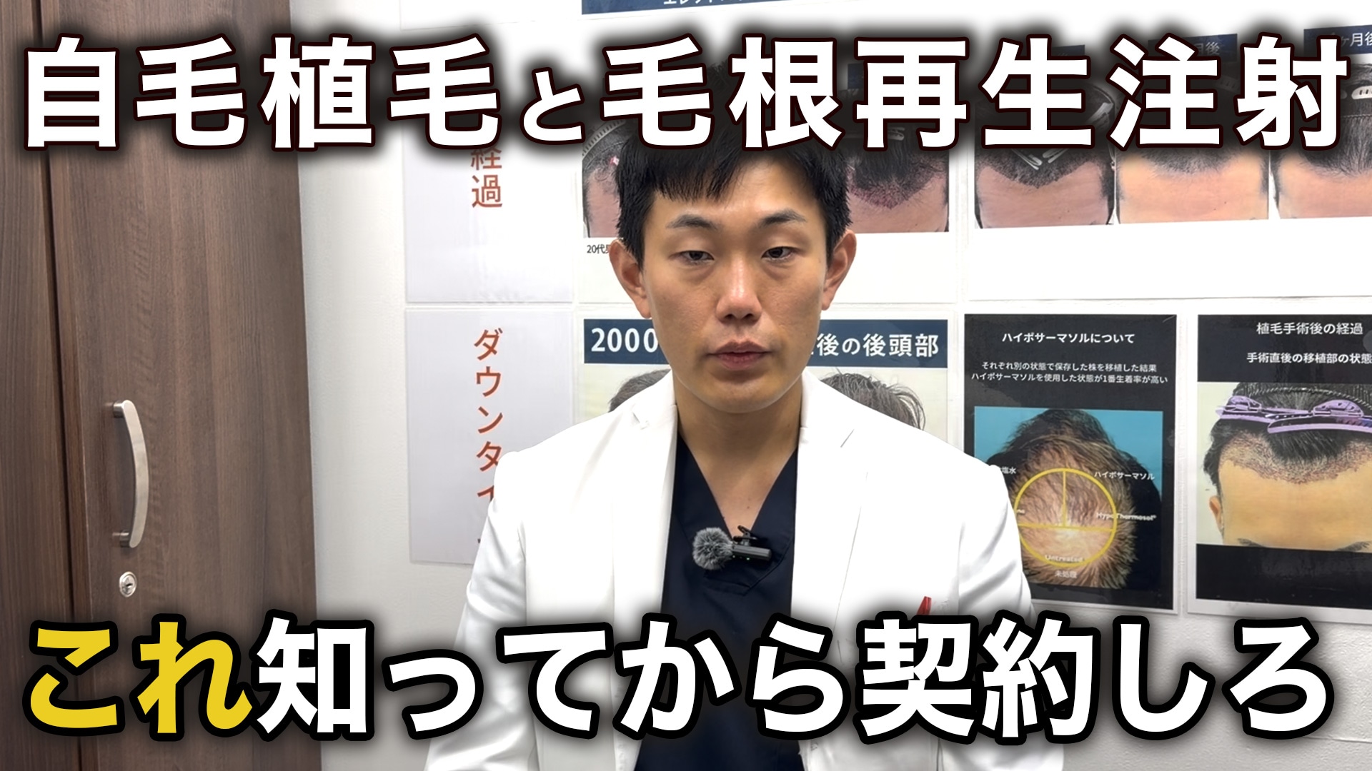 自毛植毛と毛根再生注射の違いとは？仕上がりと効果で選ぶ失敗しないAGA治療