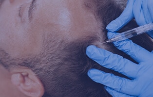 メソセラピー(種類問わず)